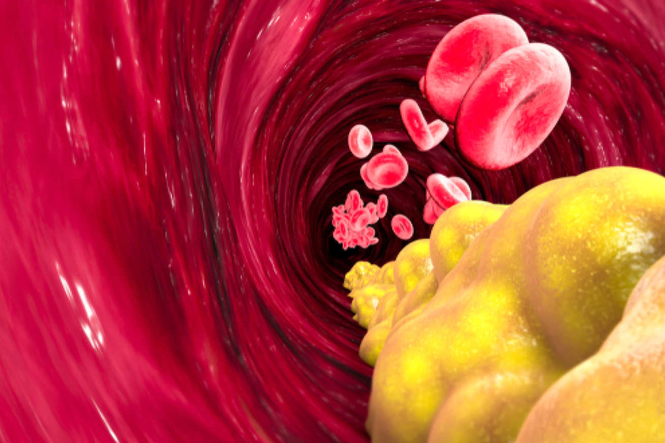 Illustration of cholesterol building up inside a blood vessel