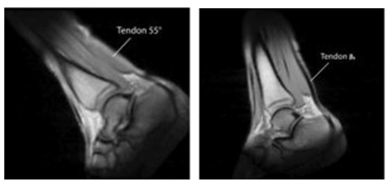 Ankle images showing the Achilles tendon