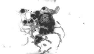 Electron micrograph of dendritic cells with lipid bodies