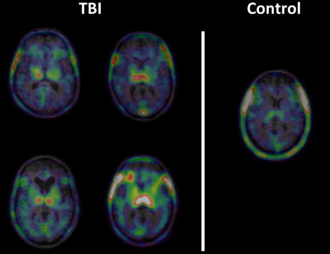 Chronic Inflammation after traumatic brain injury