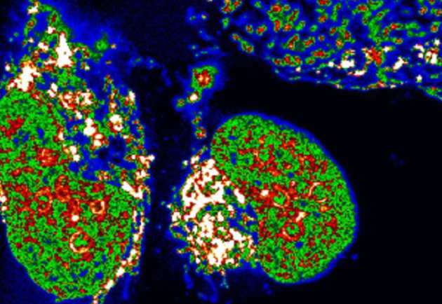   Confocal microscopy image of the new molecule inside human bone cancer cells