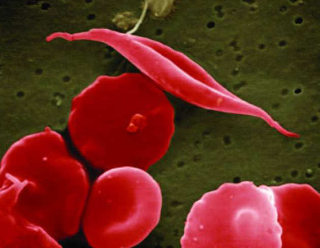 sickle-cell