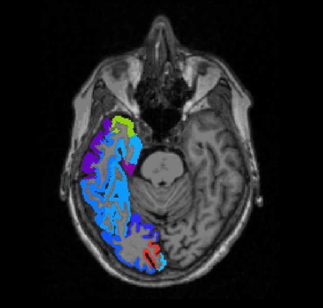 MRI biomarker for the prediction of Alzheimer’s disease