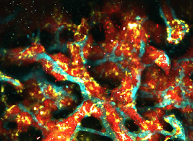 This image shows normal and malignant haematopoietic cells (yellow and red, respectively) side by side in small bone marrow cavities. In cyan are bone marrow blood vessels. Understanding how normal and malignant haematopoietic cells interact with each others will lead to the development of new anti-leukaemia drugs.