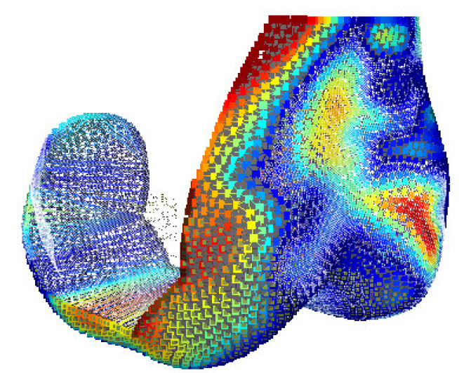 Heat map showing accuracy of fit for a patient-specific knee joint implant parametrically designed from two x-ray images