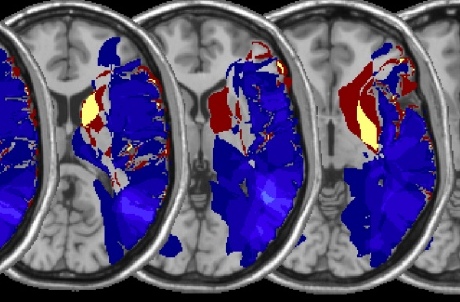 Brain scans show damage to the right striatum in patients with spatial neglect.