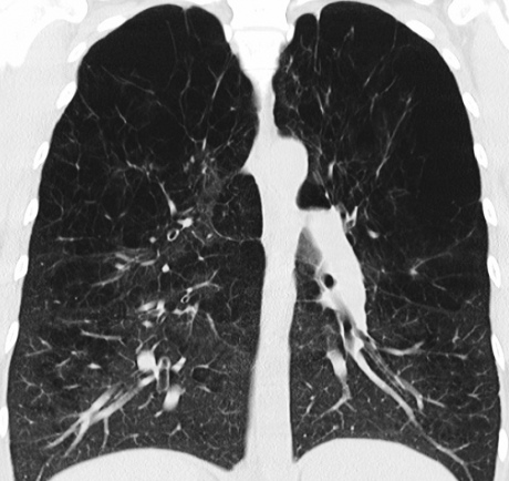 X-ray image of a patient with upper lobe emphysema