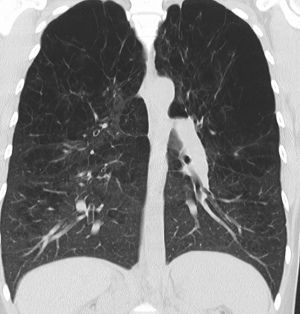 CT scan showing trapped air (black) in the lungs of an emphysema patient