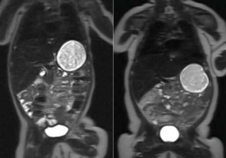 MRI scans of two babies at ten weeks old. The child on the left was born to a healthy mother, while the child on the right was born to a mother with gestational diabetes. The white area on the outside of the body is fat tissue. (The large white circle in the body is milk in the stomach)