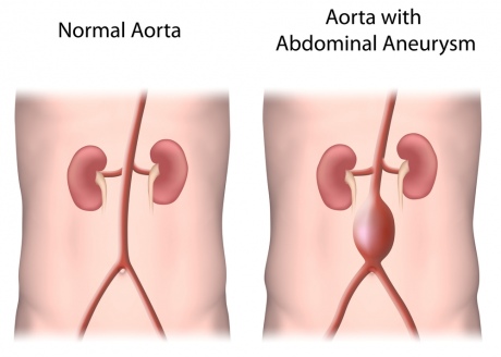 Abdominal aortic aneursym 
