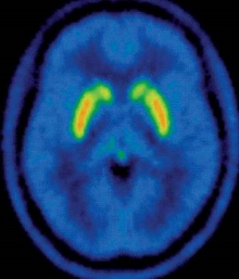 Brain scan with areas lit up