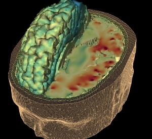 The red zone represents the parts most damaged in an NFL player's brain