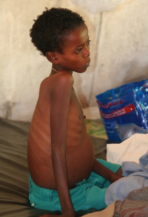 Very thin African boy with swollen abdomen