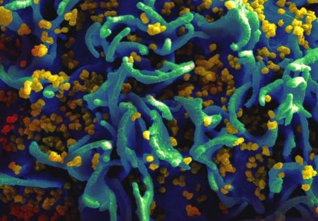 A scanning electron micrograph of HIV particles (yellow) infect a human T cell (green)