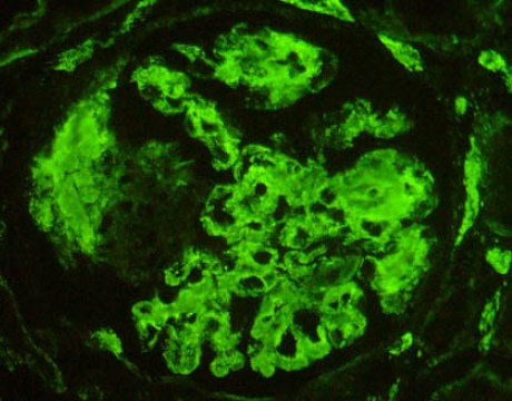 Biopsy of an inflamed kidneywith flourescent staining of antibodies