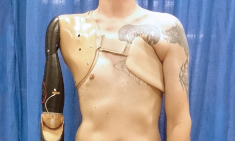 A prosthetic arm attached to a man