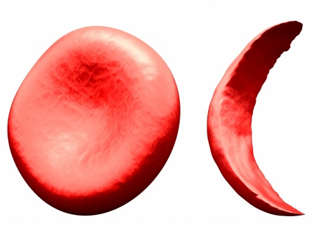 Side by side image of a normal doughnut shaped RBC and a sickle shaped RBC