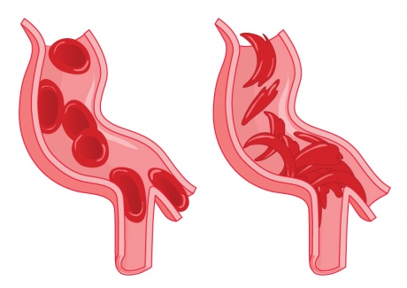 Side by side image of how normal RBCs pass easily through blood vessels, versus one with sickle RBCs that become stuck and clog blood vessels.