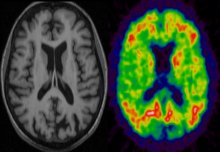 MRI-PET scanner will enable new insights into dementia 