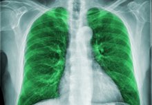 Lung cells that battle a cold virus identified by scientists 