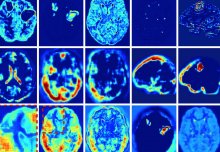 Clinician-mimicking program could improve brain injury analysis