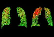 New light shed on improving treatment for COPD exacerbations