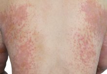 Immune system overreaction may trigger eczema into becoming long-term 