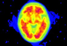 PET scans for Alzheimer's could bring benefit to more patients