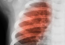 Glucose in the airways could increase infections in lung disease patients
