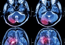 International project launches to prevent stroke in patients with brain bleeding