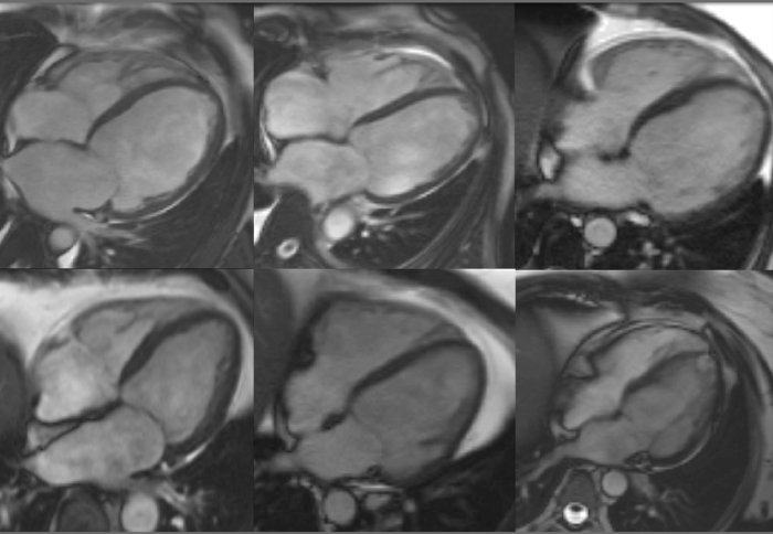 Cardiac magnetic resonance imaging (MRI) showing the hearts of six patients with dilated cardiomyopathy.