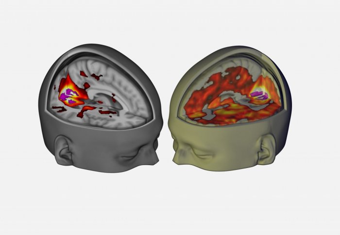 Brain on LSD vs placebo