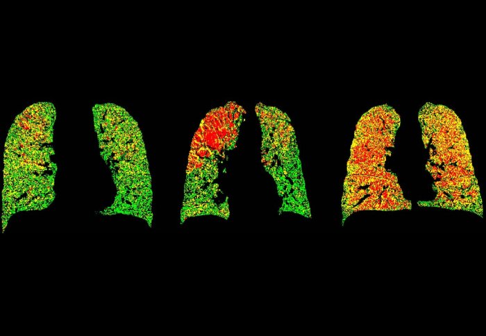 Lungs images from CT Scan by UMHealthSystem