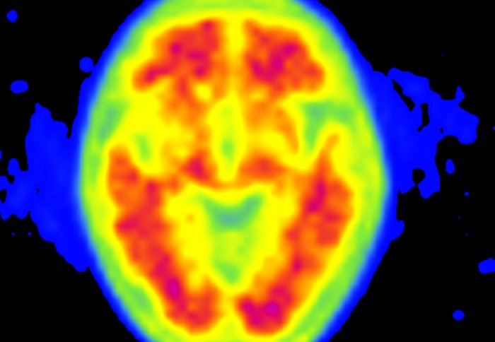 An amyloid PET scan of a patient suffering from Alzheimer's disease