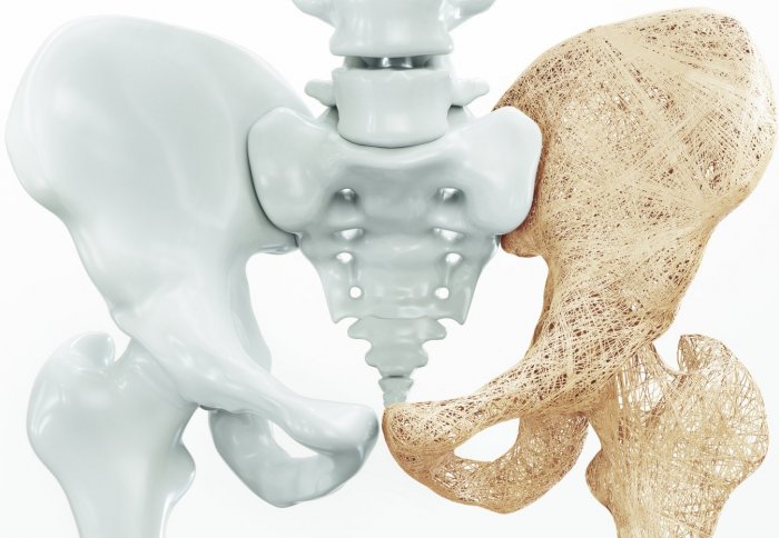 3d rendering of osteoporosis in hip bones and upper thigh bone.