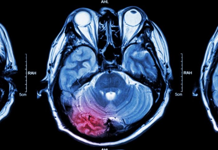 MRI images of stroke