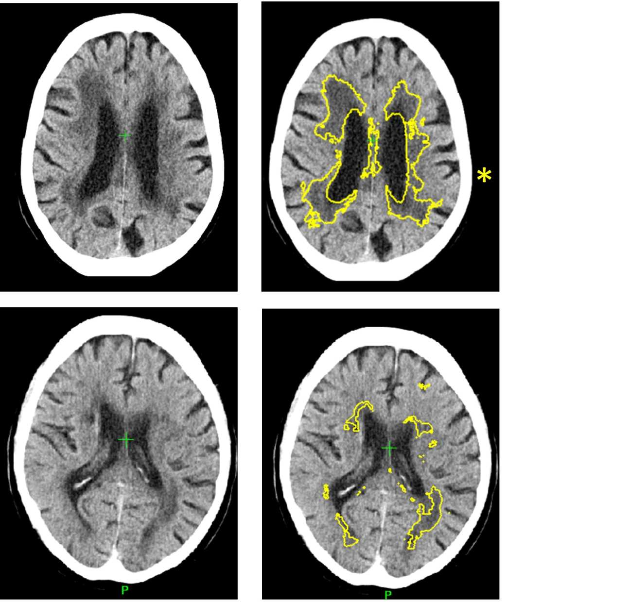 CT of small vessel disease in the brain