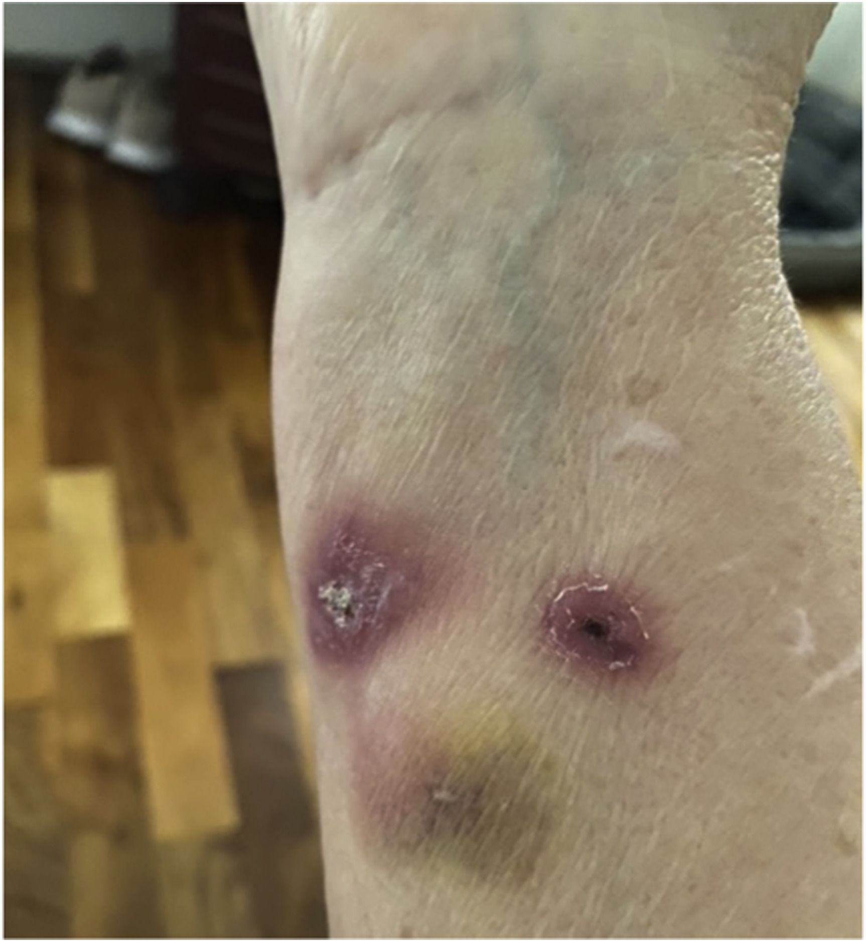 Right forearm of patient with Sporotrichosis during treament